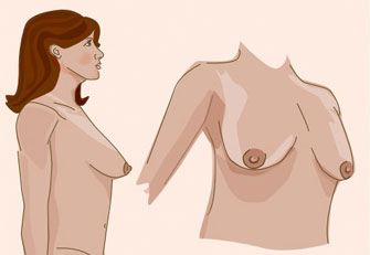 breast lift abroad
